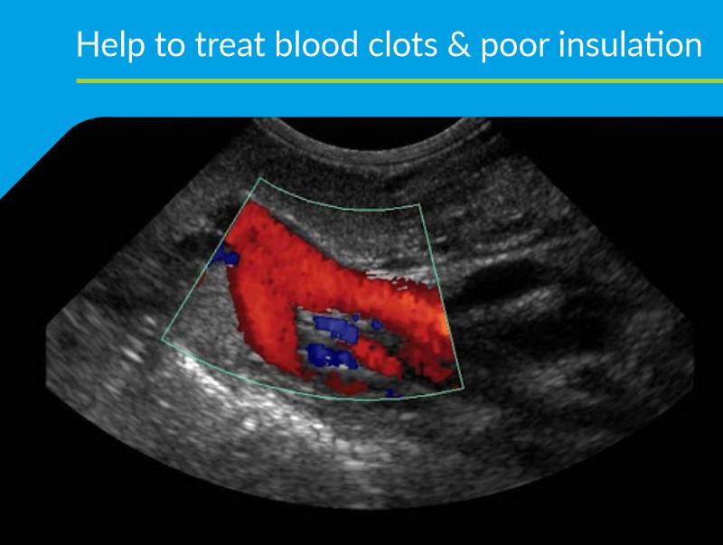 Help to tread blood clots & poor Insulation